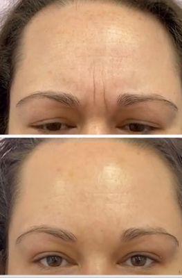 Botox before and after. 2 weeks apart.