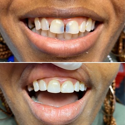 One visit smile makeover!