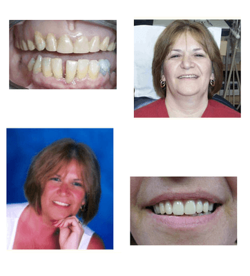 Patient presented with denture that she had worn for over 20 years.  A new upper and lower esthetic denture was made with lig...