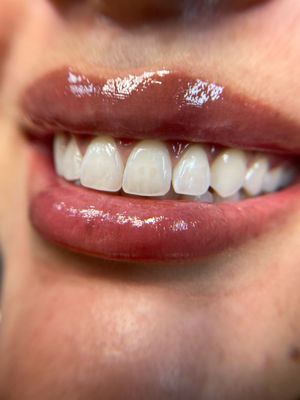 Healed Lip Blush and teeth whitening