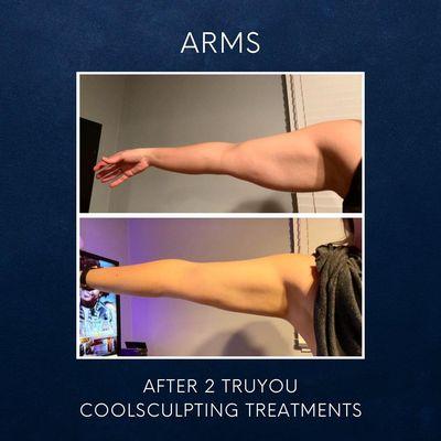 Coolsculpting Arms after 2 Treatments