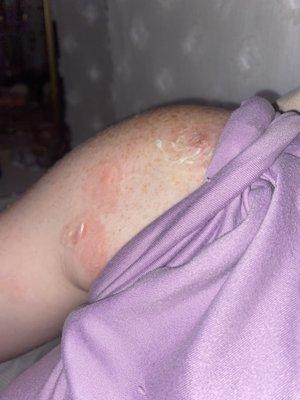 My ringworm on my arm. It's now all over body and face. Big round circles.