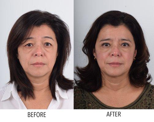 Ptosis and brow lift surgery patient.