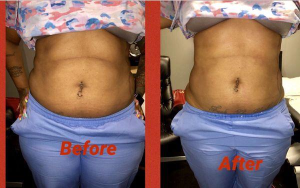 Lipo Cavitation and Lipo Laser session