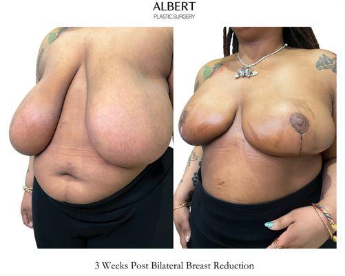 Bilateral Breast Reduction