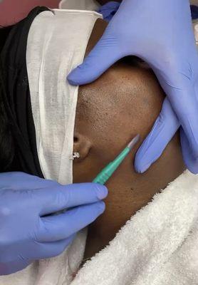 Dermaplaning Facial