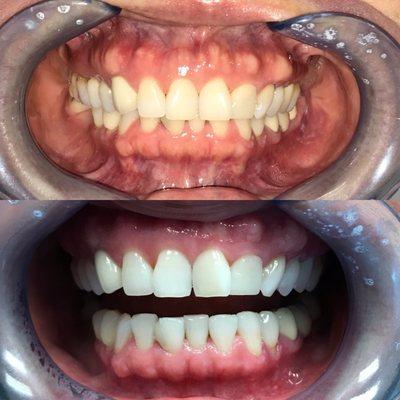 Before and after ZOOM whitening