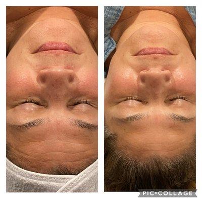 Before & after a dermaplaning facial