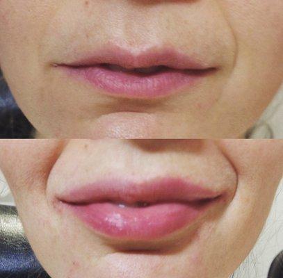 Before and after lip filler