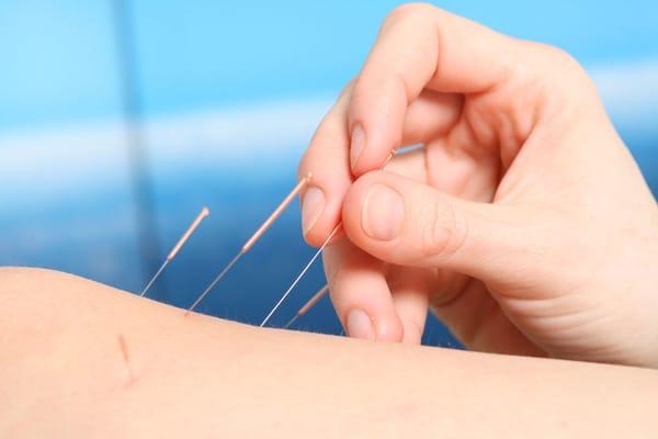 Our Acupuncturist Dr. Choong has over 45-year experience for pain relief treatment.