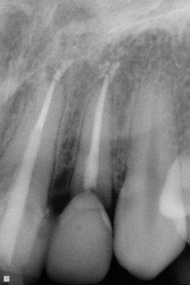 Problem root canal treated tooth. Had to be removed and implant placed the same day