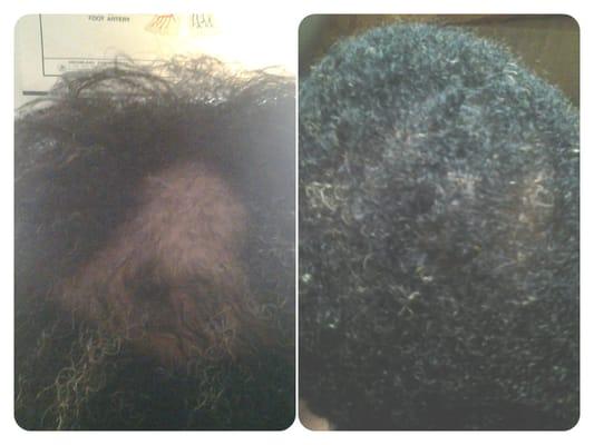 A client with Alopecia Areata stopped her hair loss and re-grew 100% of her hair.