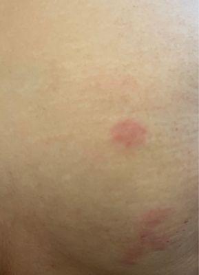 Bed bug bites