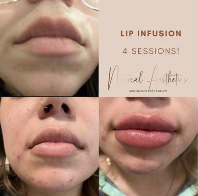 Needle-free lip infusion