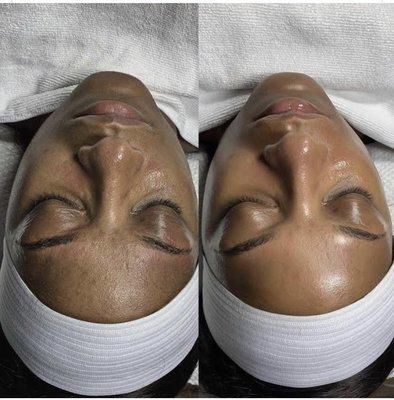 Before/ After deep cleansing facial.