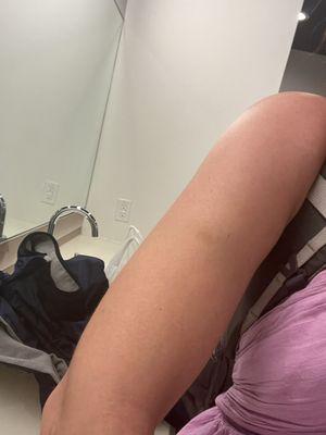 Starting to bruise on right arm