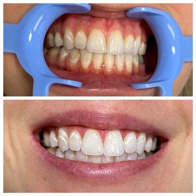 Teeth Whitening