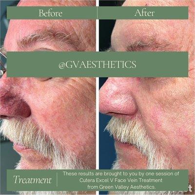 Before and immediately after treatment of those pesky face veins!