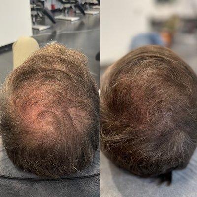 Scalp Micropigmentation