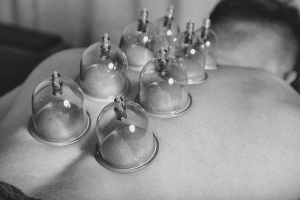 Cupping Therapy