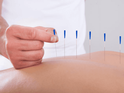 Acupuncture