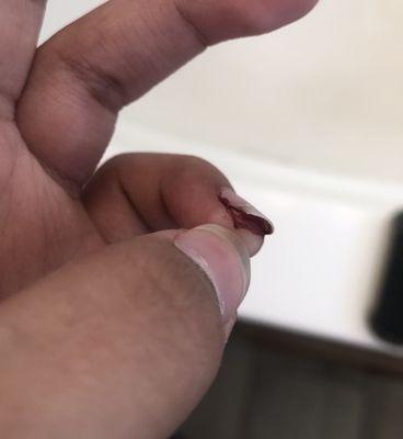 Bloody cut on nail