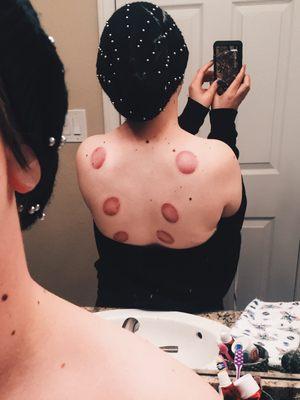 Cupping marks