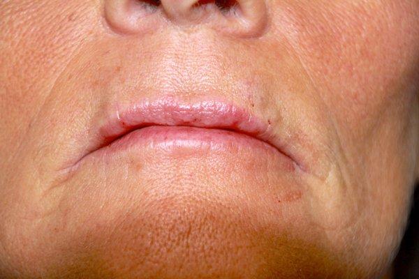 after subtle lip plumping and fine line smoothing with 1 syringe of Juvederm Volbella.