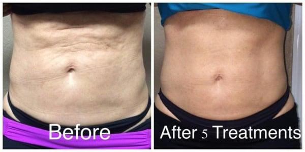 Venus Legacy Body Contouring, Cellulite Reduction and Skin Tightening Before & After.