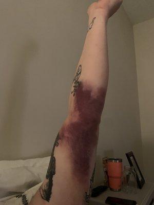 My fiancé's arm 4 days after giving blood.