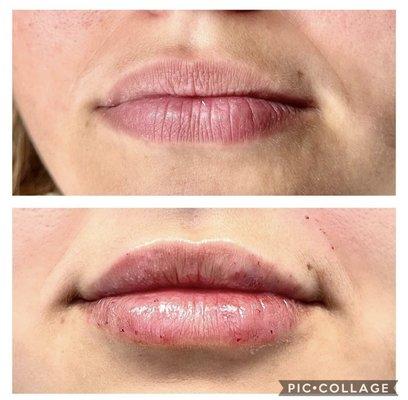 Pain free Lip Fillers