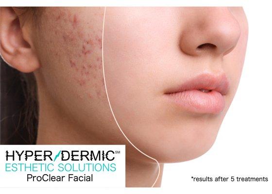 ProClear Complexion Facial Service