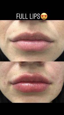 Lip enhancement