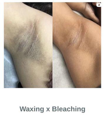 Skin Bleaching / Lightening Skin Brightening