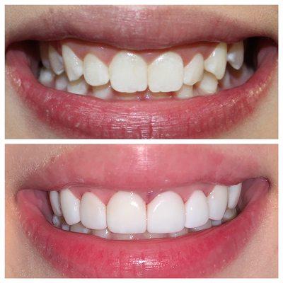 Ultra thin veneers