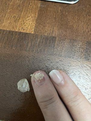 Close-up of what my nail looks like. This hurts!