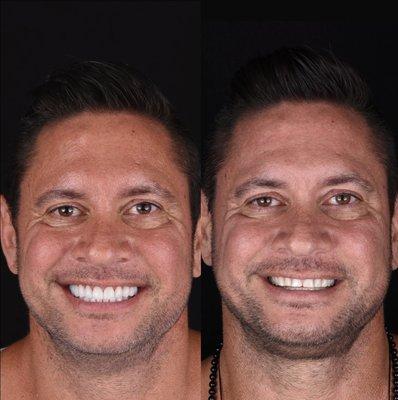 Smile transformation with full upper and lower arch veneers