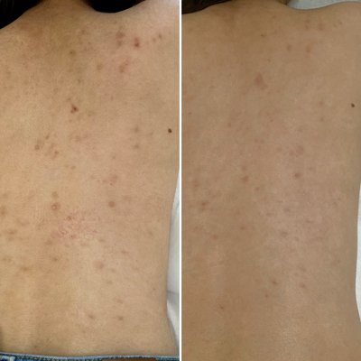 After 2 sessions of smoothing body peel