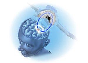 Transcranial Magnetic Stimulation