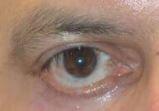 Another lower eyelid retraction example