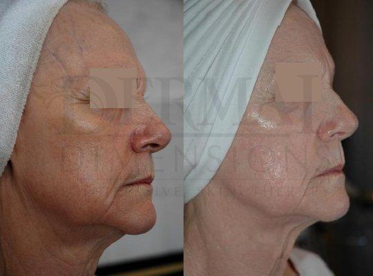 Pigmentation, lines, firmness in a 78 yr. old client.