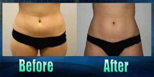 Before and after 7 sessions of non-invasive lipo