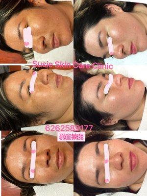 Discoloration treatment