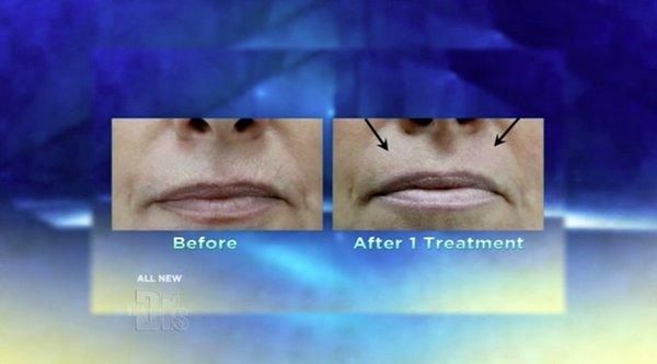 Before & After Our Unique & Popular Jet Oxygen Facial.