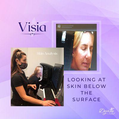 Visia Skin Analysis