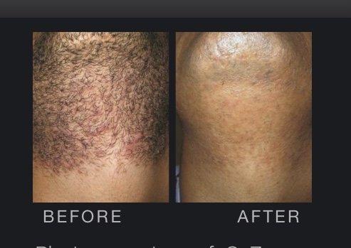 Laser Hair Removal