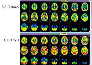 Get results with brain exercise neurofeedback