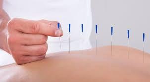 Acupuncture needles are much thinner than needles used in shots or even sewing. You'll be surprised how comfortable and relaxing it is!