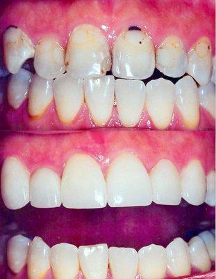 6 beautiful porcelain veneers done by our amazing Dr. Shaygan (( can you imagine the confidence boost in this happy patients life??!!))