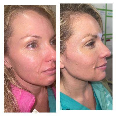 Cheek and jaw filler